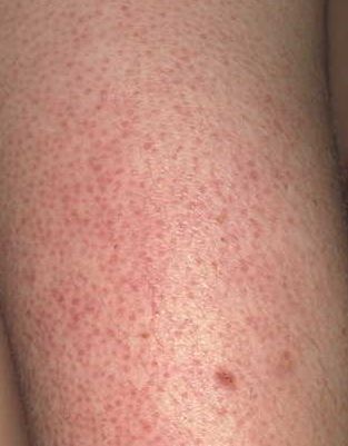 Keratosis Pilaris -otherwise know as those annoying little red bumps 